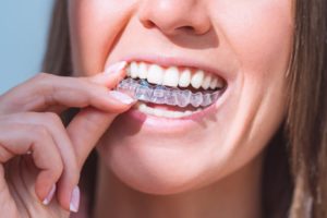 All that’s logical about Invisalign Process: Things to Know