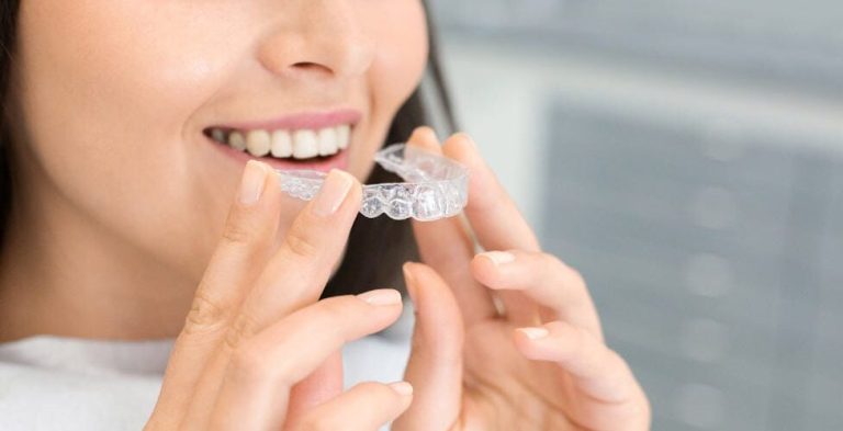 Maintenance and Care Tips for Clear Aligners in Las Vegas