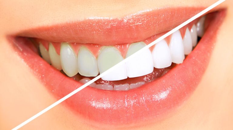 Illuminate Your Confidence: Trusted Teeth Whitening Specialists in Pasadena