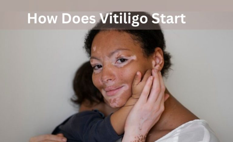 How Does Vitiligo Start And What Causes It?